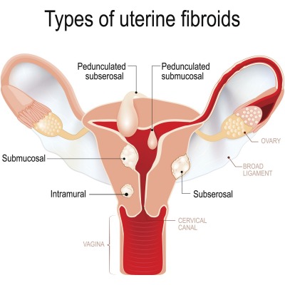 uterine fibroids illustration diagram