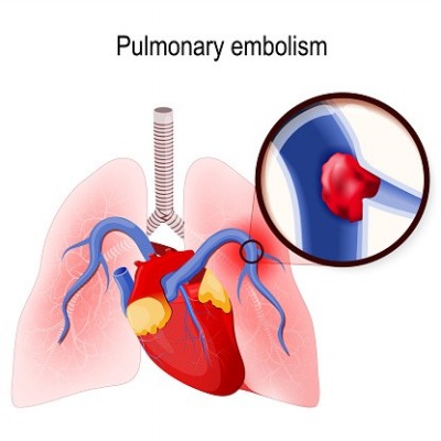 pulmonary embolism diagram illustration