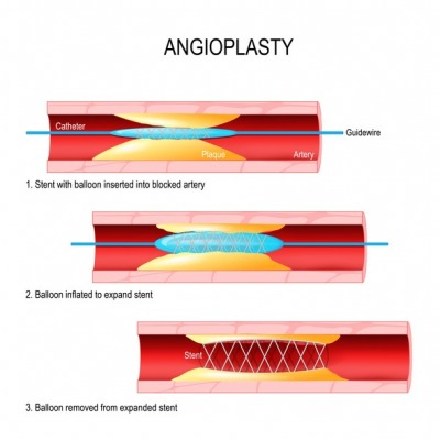 angioplasty diagram