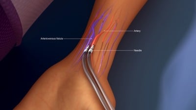 hemodialysis 3d render and diagram