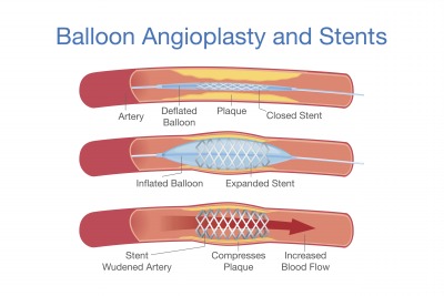 PAD treatment balloon angioplasty and stents diagram