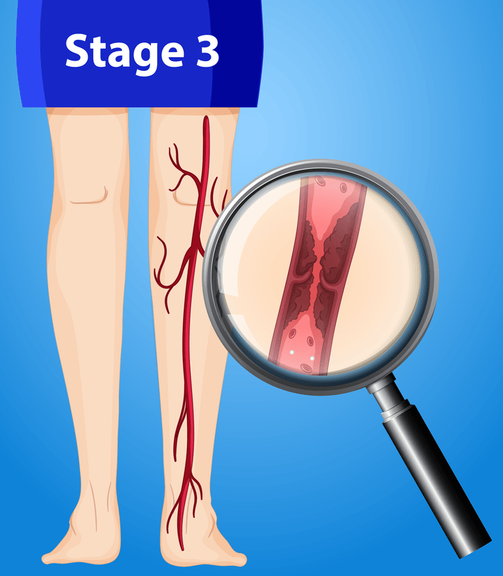 How Fast Is Dvt Deep Vein Thrombosis - New England Endovascular Center