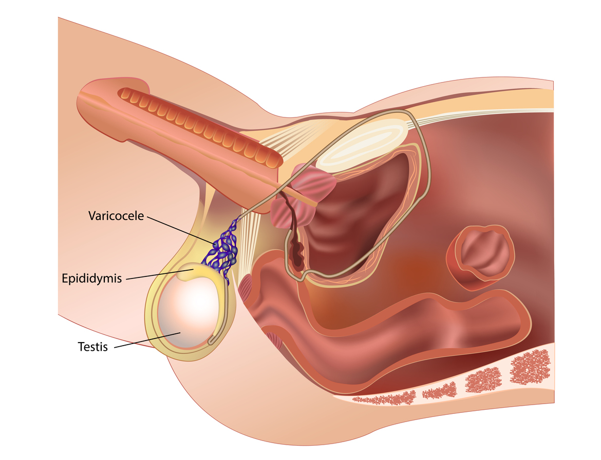 Varicocele in male reproductive system