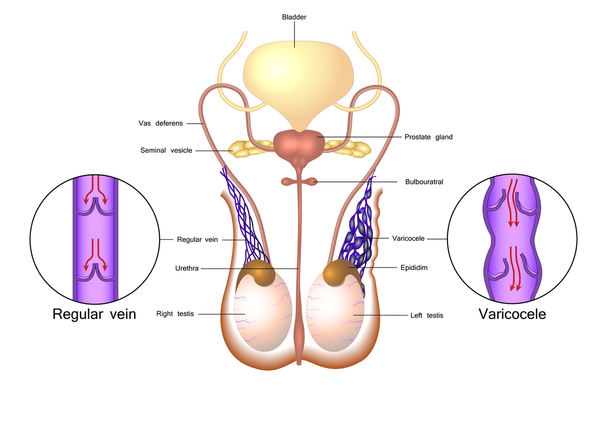 Varicocele in testicular vessels