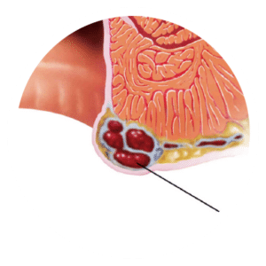 Hemorrhoids - New England Endovascular Center